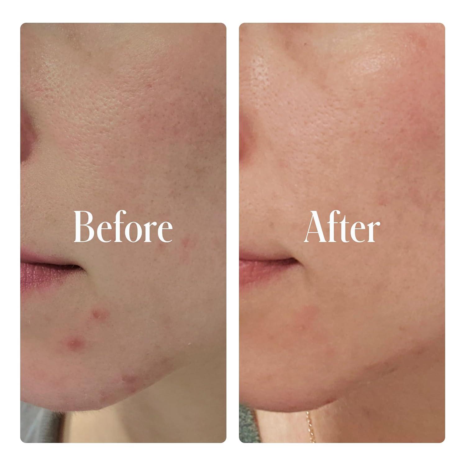 image:imageGeologie Clear System Acne Treatment 2 Salicylic Acid Clarifying Gel Cleanser 2Pack