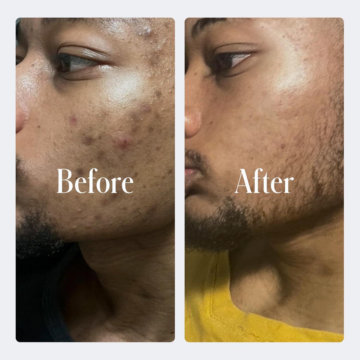 image:imageGeologie Complete Skincare Set for Men amp Women 3Month Simple amp Effective Daily Clear Skin Routine Acne Oily Skin Dark Spots Face Wash 2Pack Retinol Face Cream SPF15 Moisturizer amp Eye CreamBergamot Juniper Standard Strength 3 Month